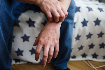 Closeup men itching and scratching by hand. Psoriasis or eczema on the hand. Atopic allergy skin with red spots