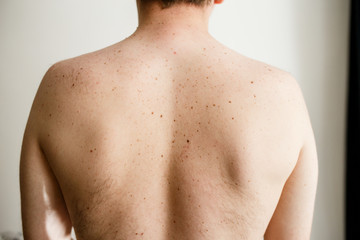 Close up detail of the bare skin on a man back with scattered moles and freckles , Disorders of...