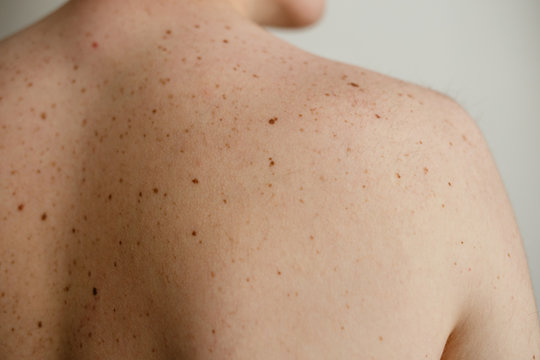 Close up detail of the bare skin on a man back with scattered moles and freckles , Disorders of body , Checking benign moles , Sun effect on skin. Birthmarks on skin