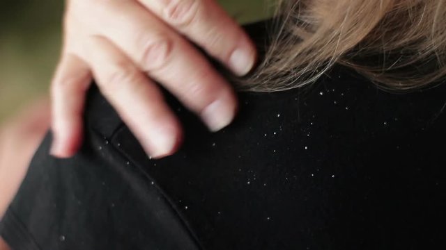 Problem skin with dandruff in a woman, close-up
