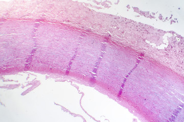 Fibrinoid necrosis of the vessel wall, light micrograph, photo under microscope
