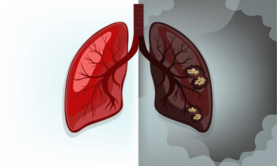 Normal lung vs Lung cancer(main causes of smoking)
