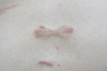 keloid skin