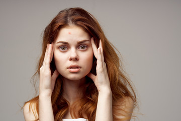 Obraz premium acne on the face of a woman dermatology