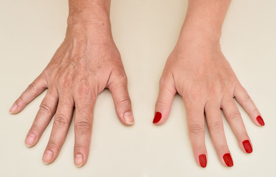 Hands of a woman before and after manicure and skin treatment