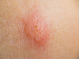 Insect bite on female skin