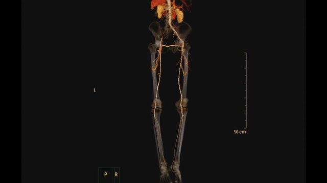 CT SCAN of lower extremity with contrast media injection shown vessels 3D rendering image.