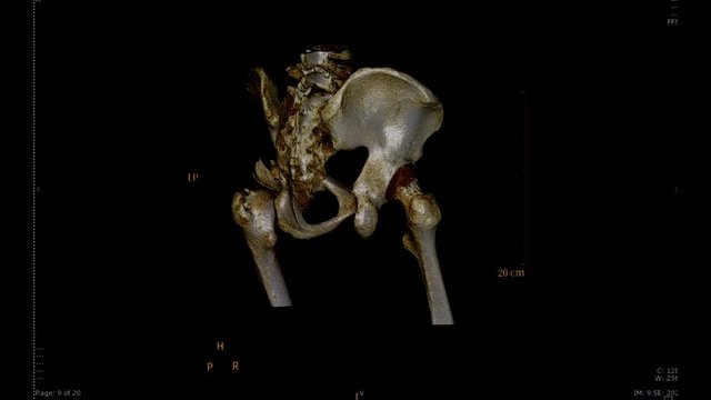 CT SCAN image of pelvic bone with Hip joint  3D rendering image. Rotating on monitor .