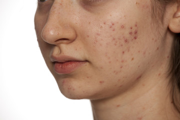 closeup of teenage girl with problematic skin on white background
