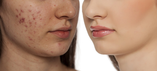 comarision portratit of teenage girl with problematic skin, before and after skin traitment on white background