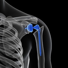 3d rendered medically accurate illustration of a shoulder replacement