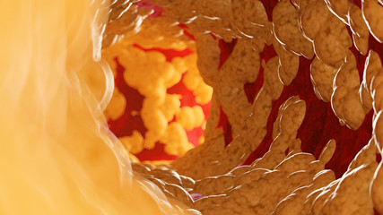 3d rendered medically accurate illustration of fat inside of an artery