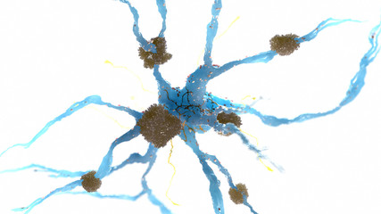 3d rendered medically accurate illustration of amyloid plaques on a nerve cell - alzheimer disease