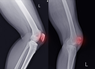 X-ray Left Knee lateral Showing Kneecap normal and fracture red color marker.