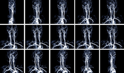 MRA Brain (Magnetic Resonance Angiography)of the blood vessels in the brain and cerebrovascular disease. brain stroke x-ray image.