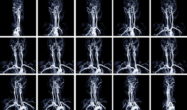 MRA Brain (Magnetic Resonance Angiography)of the blood vessels in the brain and cerebrovascular disease. brain stroke x-ray image.