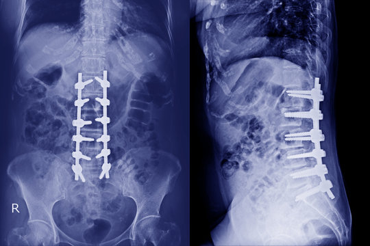 X-ray Lumbar spine AP,Lateral : A human and postoperative treatment for degenerative lumbar disc disease by decompression and fix by iron rod and screws.Blue tone.