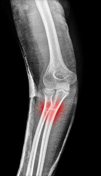X-ray consolidation fracture of lower leg bones