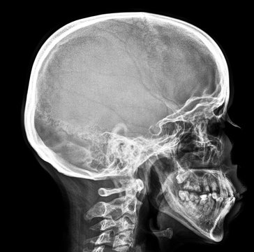 X-ray of the skull in the lateral projection