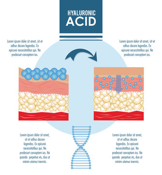 Hyaluronic Acid Filler Injection Infographic