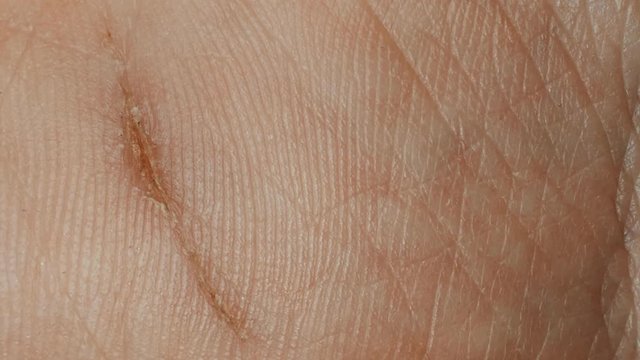 withered wound on the skin of hand, macro