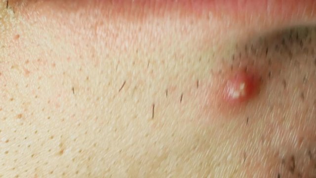 pimple under the lip, non groomed and ditry male skin, macro