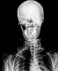 X-ray picture of the skull