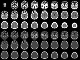 CT Scan Brain a male 38 year old.Finding Fracture frontal bone  with extra-axial hematoma at...
