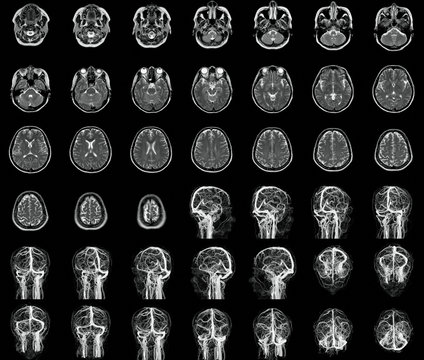 MRI and MRA brain collection, x-ray film of the brain, computed tomography.