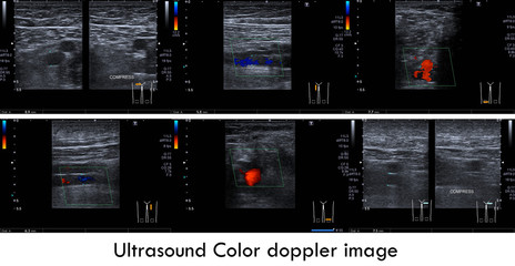 Ultrasound color doppler image:Normal doppler signal of superficial femoral v. and popliteal v. bilaterally.No sign of thrombus in the veins. - obrazy, fototapety, plakaty