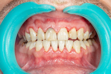 Close-up of a person's teeth after removing and cleaning a plaque in a dental clinic. Healthy smile...