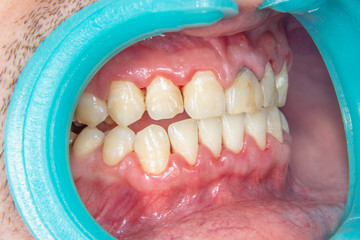 Close-up of a person's teeth after removing and cleaning a plaque in a dental clinic. Healthy smile...