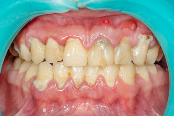 Plaque of the patient, stone. Dentistry treatment of dental plaque, professional oral hygiene. The...