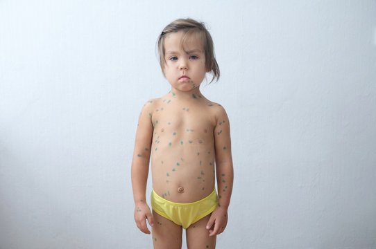 Child with chickenpox. Sick little girl  with varicells making eruption on skin. Long home quarantine, then having immunity for ever.