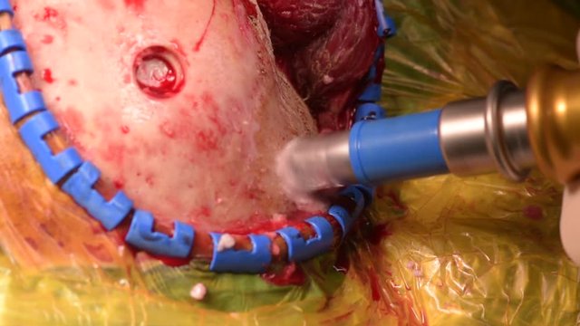 Neurosurgeon performing brain surgery