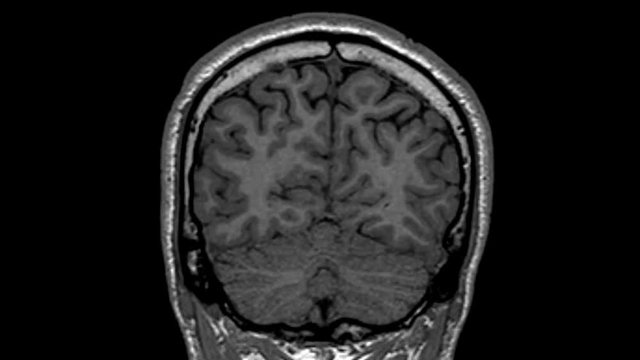 Magnetic Resonance Imaging scan from the coronal view of a human brain