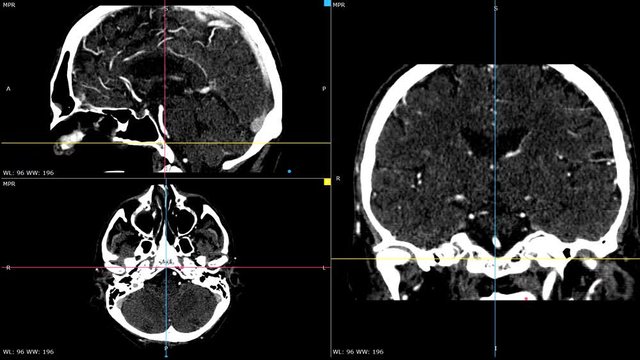 Live image video of a medical brain tomography from three cross sectional perspectives