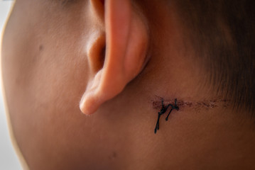 The wound was sewn with black yarn due to torn skin.