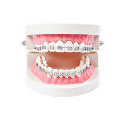 tooth model with metal wire dental braces.