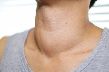 Asian lady woman patient have abnormal enlargement of thyroid gland Hyperthyroidism (overactive...