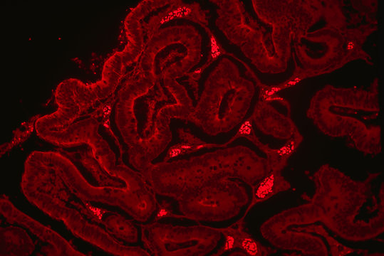 Intestinal adenomatosis