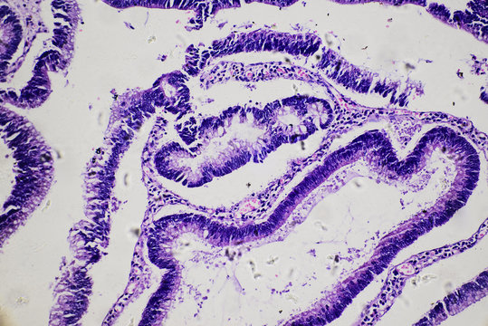 Intestinal adenomatosis