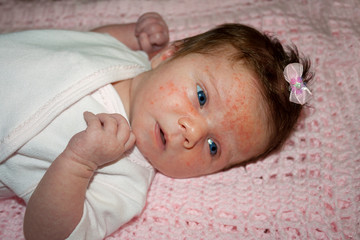 Newborn Baby with Severe Baby Acne