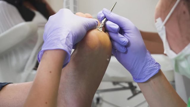 Podology treatment. Podologists using scalpel to remove a callus from customer