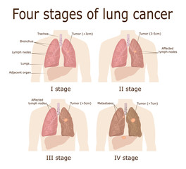 Four stages of lung cancer
