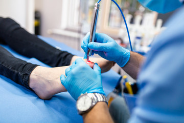 Toenail fungus treatment with foot laser at laser nail therapy clinic.. © hedgehog94