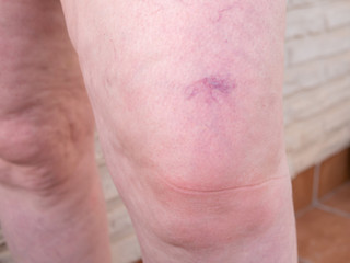 Knee of mature woman
