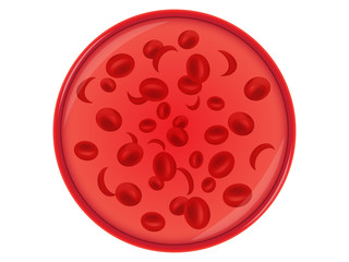 Sickle cell anemia