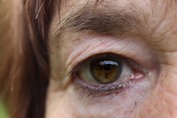 Grünes Auge einer älteren weiblichen Person mit implantierter künstlicher Linse nach...