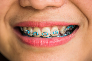 closeup mouth with teeth brace and smile